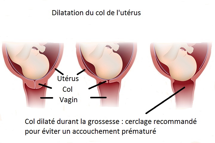Cerclage