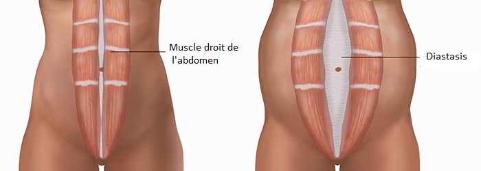 Diastasis