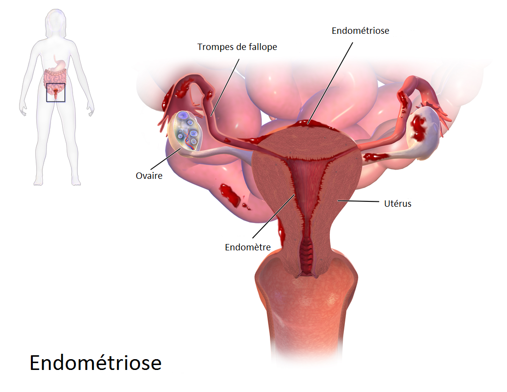 Endométriose