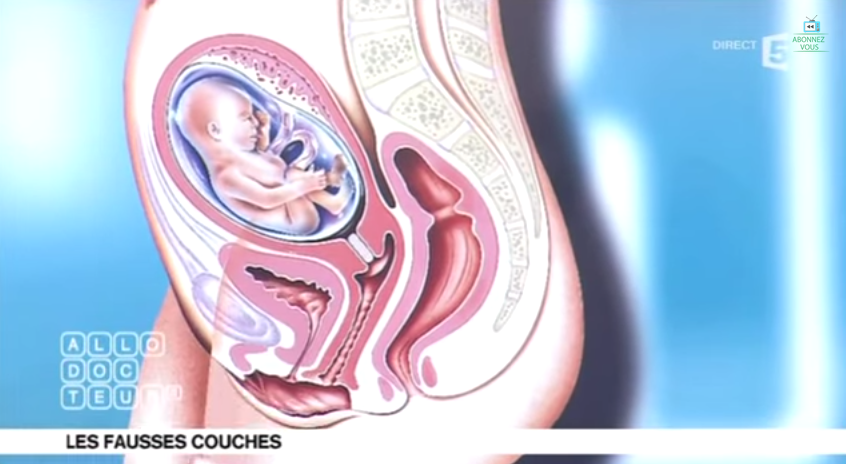 Que doit-on savoir sur la fausse couche ?