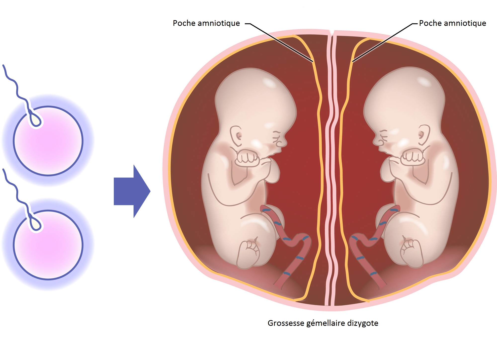 Grossesse gémellaire dizygote