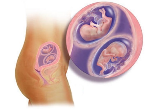 Grossesse gémellaire