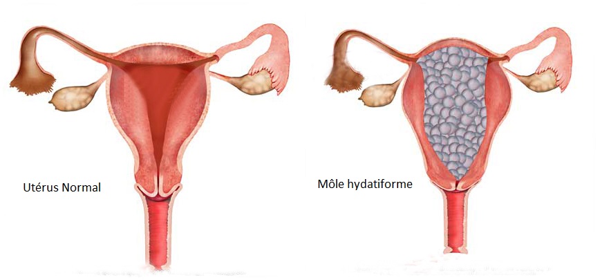Môle hydatiforme