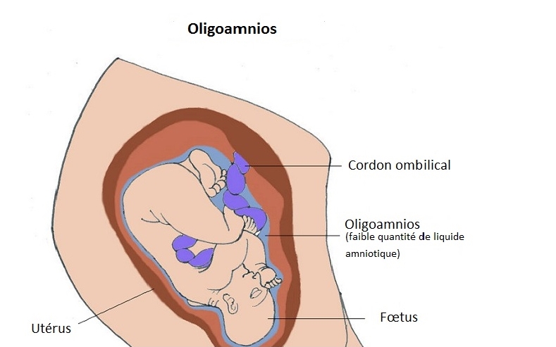 Oligoamnios