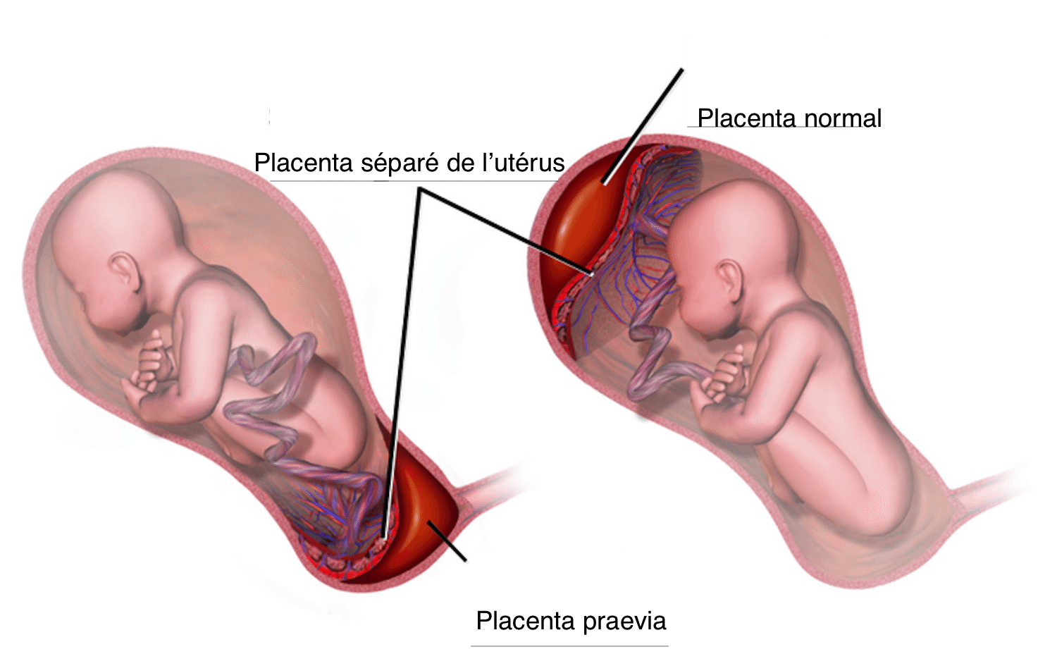 Placenta praevia