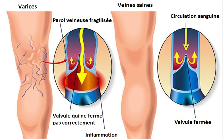 Varices