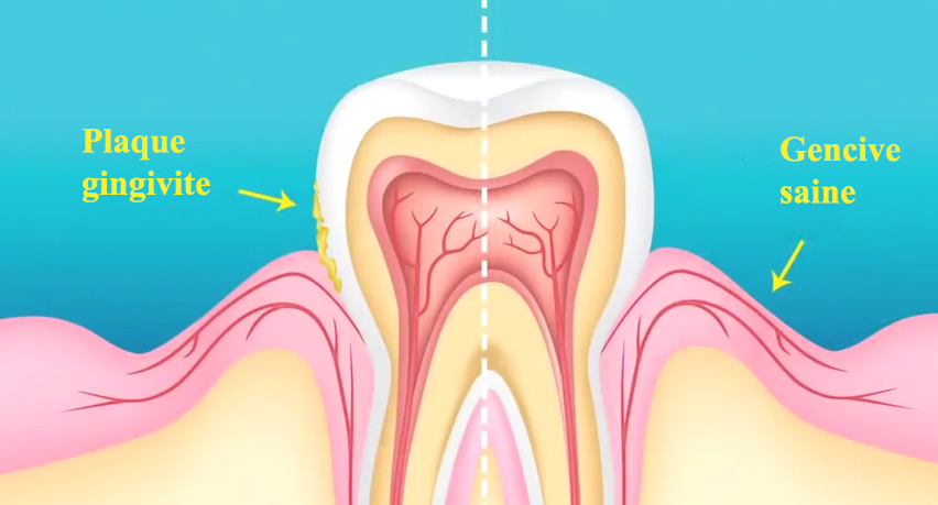 Gingivite de grossesse