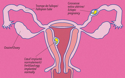 Grossesse extra-utérine