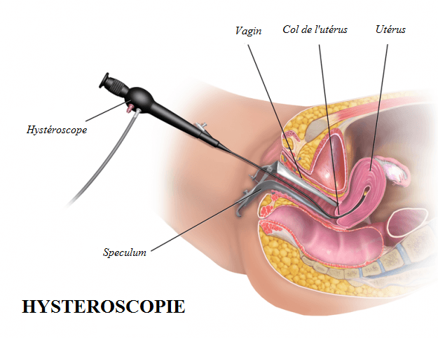 Hystéroscopie
