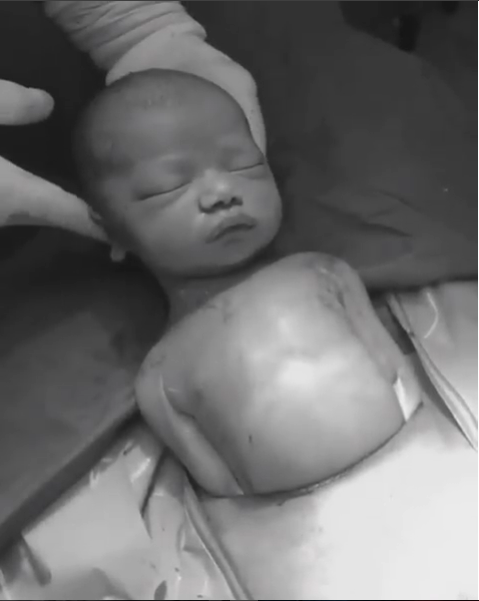 Né par césarienne naturelle : pourquoi la naissance de ce bébé est spectaculaire ?