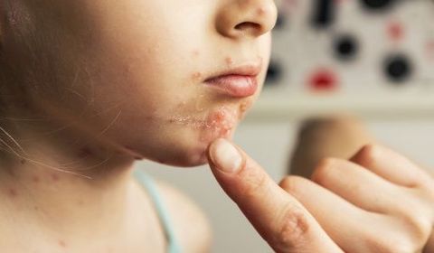 L’impétigo chez l’enfant : comment reconnaître et soigner cette infection ?