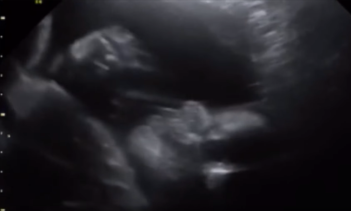 Vidéo : Ce bébé fait coucou à ses parents lors d’une échographie