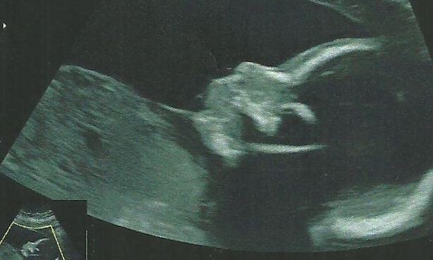 Témoignage : Atteinte du syndrome des ovaires polykystiques, mon parcours pour enfin donner la vie